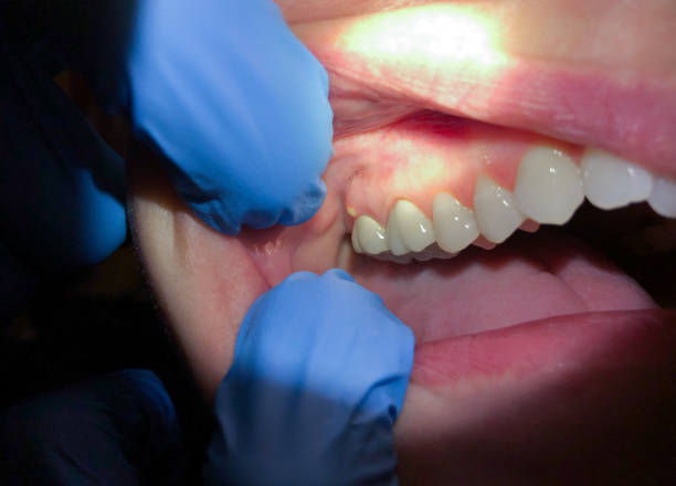 Best Emergency Tooth Extraction in Bude, MS
